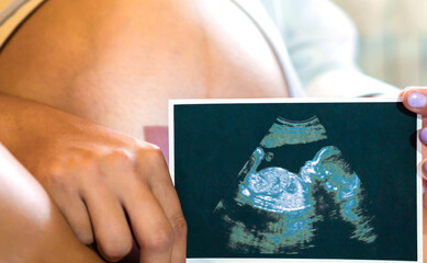 A pregnant girl holds a close-up ultrasound picture of her baby in her hands. The concept of...