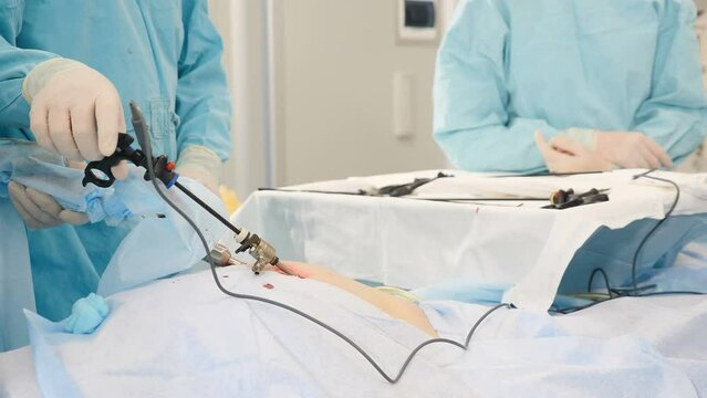 Laparoscopic cholecystectomy instrument. Real Surgery, abdominal incision, working with surgical laparoscopy instruments. Doctor hands in sterile gloves holding trocar for laparoscopy procedure. 4 k