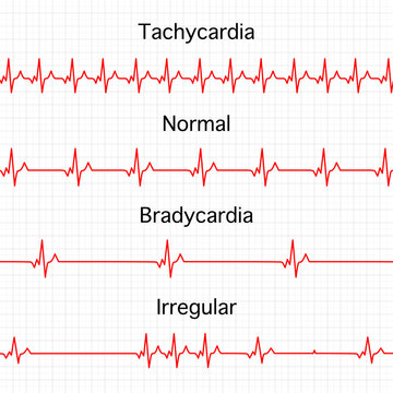 Heart rate graphics. Vector illustration. Electrocardiogram. illustration of medical electrocardiogram - ECG on chart paper. Tachycardia, normal, Bradycardia, Irregular heart beat.