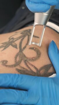 Laser tattoo removal by a professional to a client