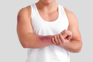 Man with bruises on arm against light background