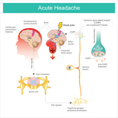 Acute Headache. Diagram learning The Acute Headache as a result a process of the brain and consequences expanded the blood vessel.. - obrazy, fototapety, plakaty