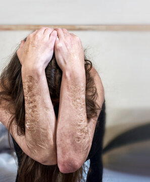Woman covers her head behind arms with heavy Cuts and scars of self-mutilation in frustration, Borderline personality disorder in worry