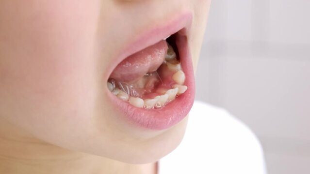 Child shows his loose milk tooth presses and pushes it with his tongue. Open mouth close-up. Caucasian 6 year old kid in a white T-shirt on a bathroom background. lower incisor. Copy space. Body part.
