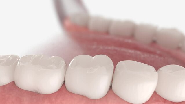 3d animation of proces tooth dentistry restoration with ceramic sealant.