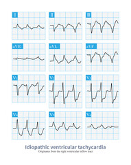 The electrocardiogram is an idiopathic ventricular tachycardia originating from the right ventricular inflow tract, a benign ventricular tachycardia.