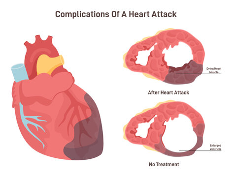 Heart attack complications. Heart wall thining and ventricle enlargening