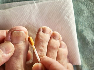 A solution of propolis is applied to the nail affected by the fungus. Treatment of fungal nail...
