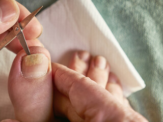 The nail cavity is cleaned with scissors. Treatment of fungal nail diseases.