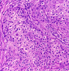High grade mucoepidermoid carcinoma of parotid cyst. Microscopic show parotid tissue, features of mucoepidermoid carcinoma, reactive changes. Histology. Parotid cancer.