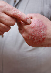 Close up of male showing hands with cracked, hard, horny, flaky skin. Dermatological problems of...
