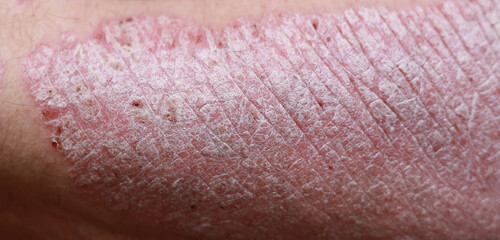Fototapeta premium Close up, macro of psoriasis skin, autoimmune disease that affects the skin cause skin inflammation red and scaly. Skin allergy with severe symptoms. Dermatitis rash and ugly eczema.