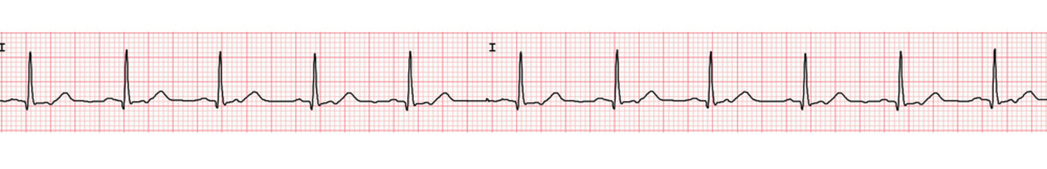 banner or ECG example of a normal sinus rhythm 