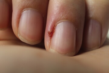 damaged finger nail nail plate with wound inflammation close-up. Hand care nail diseases nail diseases
