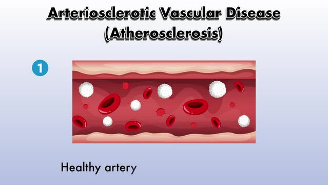 Arteriosclerotic vascular disease (Atherosclerosis) animation