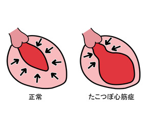 たこつぼ型心筋症