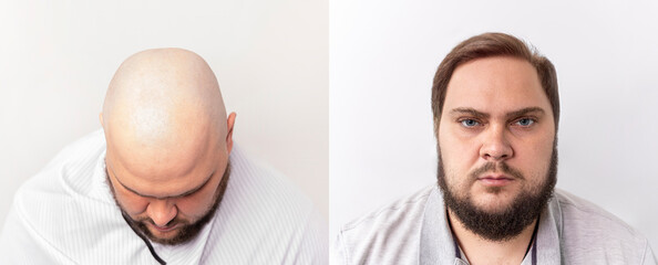 before and after bald head of a man. the process of hair transplantation on the head. treatment of...