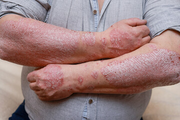 Psoriasis skin with red wounds. Male arms with cracked, hard, horny, flaky skin. Dermatological problems of allergy, eczema. Hand stains, rash, dry skin. The concept of chronic disease treatment