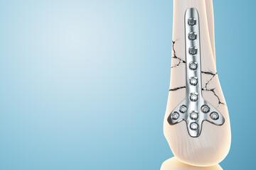 Medical procedure, osteosynthesis operation, surgical repositioning of leg bones. Fixation of a broken bone with a metal plate, technology, fixation of a fracture. 3D render, 3D illustration.