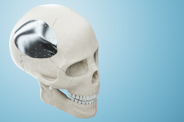 Medical procedure, osteosynthesis operation, surgical reposition of the skull. Fixation of a broken bone with a metal plate, technology, fixation of a fracture. 3D render, 3D illustration.