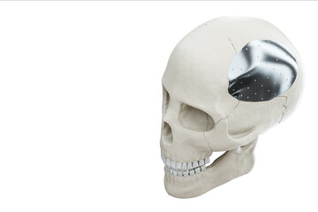 Medical procedure, osteosynthesis operation, surgical reposition of the skull. Fixation of a broken bone with a metal plate, technology, fixation of a fracture. 3D render, 3D illustration.