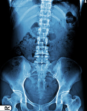 X-ray Image Abdomen Supine Position