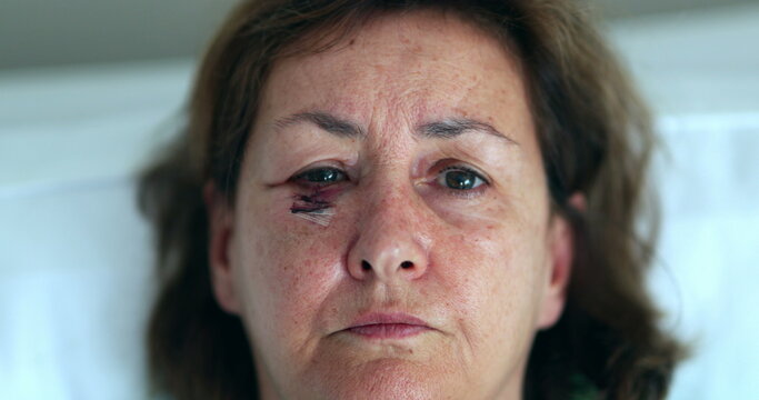 Older woman with bruise scar face opening eyes looking to camera