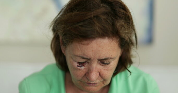 Older Woman With Face And Bruise In Face Looking Down, Sad Emotion