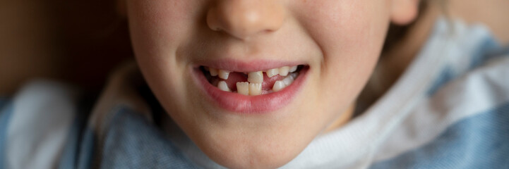 Toddler boy smiling with missing baby teeth - obrazy, fototapety, plakaty