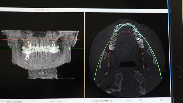 CT scan of patient with malocclusion, Jaw scanning, digital imprint, medical digital technology. Jaw MRI at modern dental clinic. X-ray ct image on computer screen. Diagnostic medical equipment 4 k