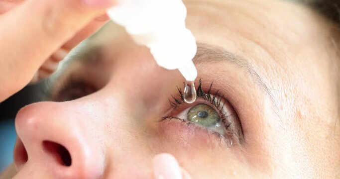 Closeup of woman pouring drops into red eye with conjunctivitis or glaucoma