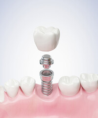 Closeup white tooth and gum with Dental implant , Human Teeth for Medical Concept, 3d illustration.