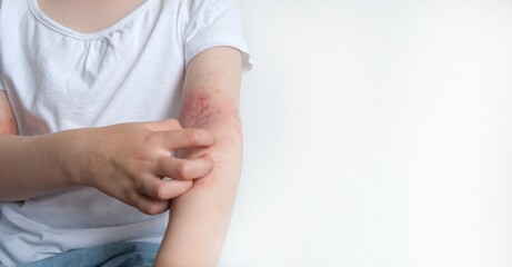 The child scratches atopic skin. Dermatitis, diathesis, allergy on the child's body.	