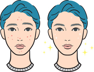 ニキビのある若い男性のビフォーアフター