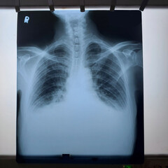 Chest x-ray image with pleural effusion