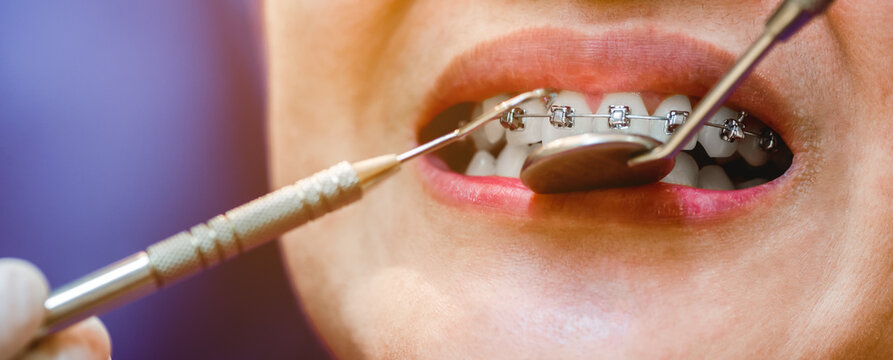 Dental braces in happy womans mouths on brackets on the teeth after whitening. Self-ligating brackets for perfect smile. Orthodontic teeth treatment.