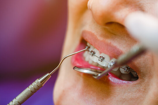 Dental braces in happy womans mouths on brackets on the teeth after whitening. Self-ligating brackets for perfect smile. Orthodontic teeth treatment.