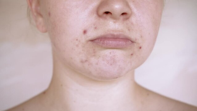 Close up of skin problems, unhealthy skin with acne and pimples. Porous, demodex and rosacea, red rashes. The concept of care for problem skin. Allergic and redness.