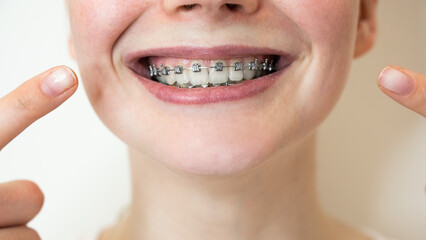Close-up portrait of a young woman pointing at a smile with braces on her teeth.