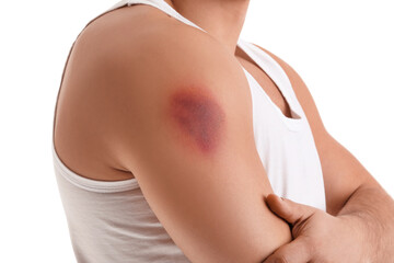 Man with bruise on shoulder against white background, closeup