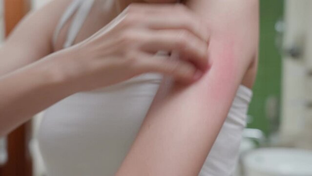 skin problem and beauty. Young woman scratch body has itchy skin from skin allergic, steroid allergy, sensitive skin, red from sunburn, chemical allergy, rash, insect bites, Seborrheic Dermatitis.