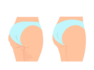 Vector of a woman with cellulite vs healthy skin.
