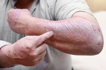 Acute form of psoriasis skin. Male showing arm with cracked, hard, horny, flaky skin. Dermatological problems of allergy, eczema. Hand stains, rash, dry skin. The concept of chronic disease treatment