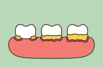 step of periodontitis or gum disease that is inflamed and has blood - dental cartoon vector flat style