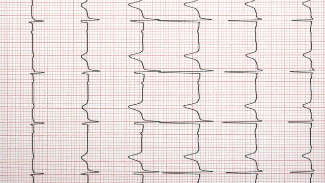 held vertical shot of ECG example of a normal sinus rhythm, precordial leads