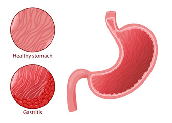 Human healthy stomach and gastritis vector illustration. Cartoon style, white background
