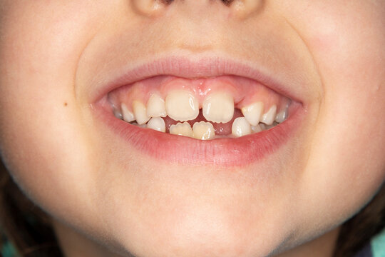 Closeup of young child smiling with missing toeeth th and permanent teeth - healthy teeth concept