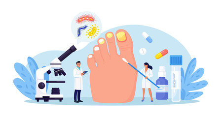 Onychomycosis. Feet with nail disease. Fungal nails infection. Doctors exam, treat nails psoriasis. Doctor dermatologist analyzes psoriatic toenails. Inflammation of toenail skin. Medical treatment - obrazy, fototapety, plakaty