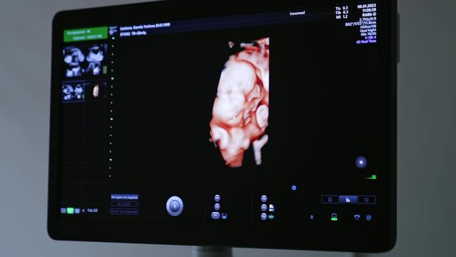 Ultrasound image of unborn baby on the black screen of equipment. The child is watched in diverse positions. Close up.