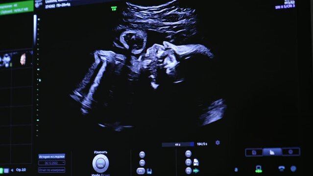 Watching the unborn baby move in mom’s abdomen. Child image on the screen of ultrasound machine.